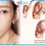 Lấy sụn tai nâng mũi có đau không – Bác sĩ BV Hồng Hà giải đáp