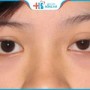 Mắt to mắt nhỏ: Nguyên nhân, ảnh hưởng và cách khắc phục triệt để