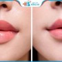 Thu mỏng môi – Cải thiện khẩu tướng, cho môi xinh quyến rũ