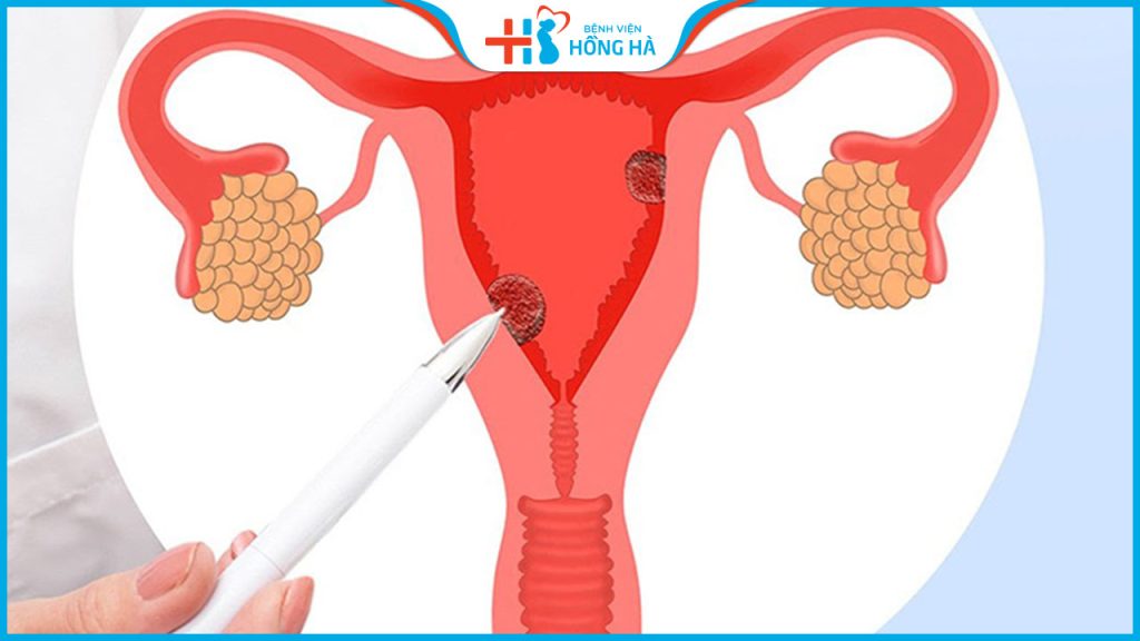 Đa nang buồng trứng có bơm tinh trùng được không – Giải đáp từ chuyên gia