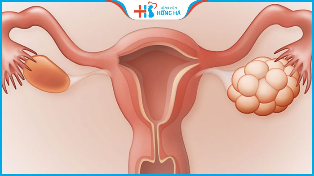 Những phương pháp chữa trị hiệu quả cho bệnh đa nang buồng trứng