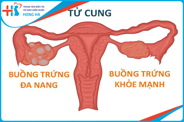 Khả năng mang thai của phụ nữ mắc bệnh buồng trứng đa nang