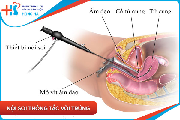 Mổ nội soi thông tắc vòi trứng thành công 90% trường hợp