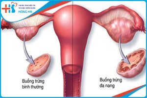 Cách chữa đa nang buồng trứng dân gian hiệu quả và an toàn