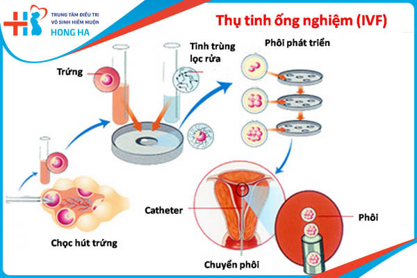 Cách tính tuổi thai IVF: Số liệu thành công đạt đến 90%