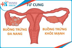Đa nang buồng trứng 1 bên: Nguyên nhân, triệu chứng và cách điều trị hiệu quả