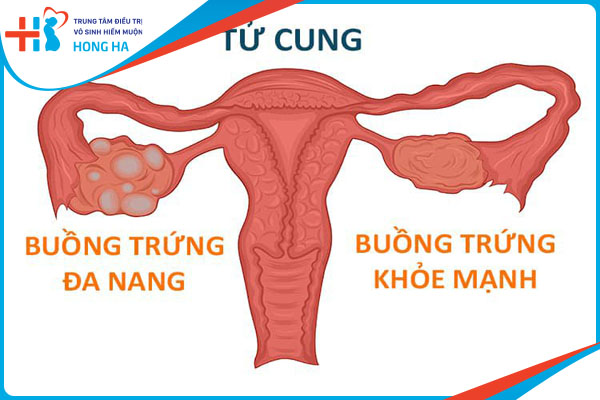 Đa nang buồng trứng 1 bên: Nguyên nhân, triệu chứng và cách điều trị hiệu quả