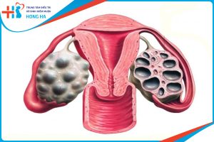 Đa nang buồng trứng: Nguyên nhân, triệu chứng và điều trị cho 20% phụ nữ