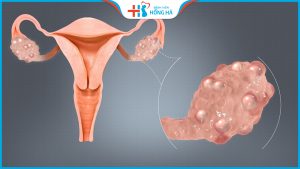 Buồng trứng đa nang: Nguyên nhân, triệu chứng và cách điều trị