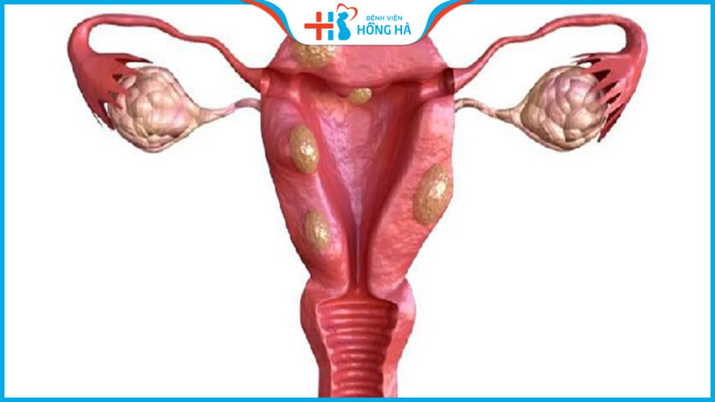 7 Biến chứng nguy hiểm của đa nang buồng trứng