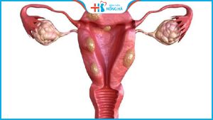 7 Biến chứng nguy hiểm của đa nang buồng trứng