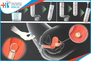 Tăng tỷ lệ thành công IUI lên đến 75%: Những kinh nghiệm quan trọng