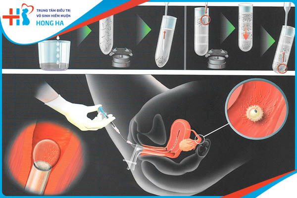 Những cách chăm sóc bản thân sau IUI để giúp phục hồi nhanh chóng và làm giảm triệu chứng?
