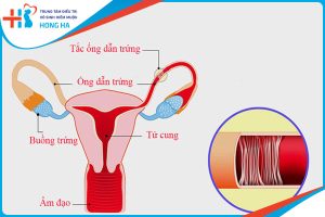 Tắc vòi trứng và ảnh hưởng đến kinh nguyệt: Những điều cần biết
