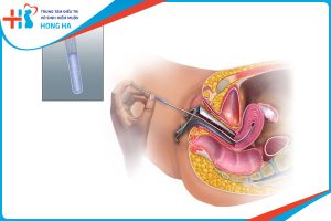 Chuẩn bị cho quá trình bơm tinh trùng: Để đạt hiệu quả cao nhất