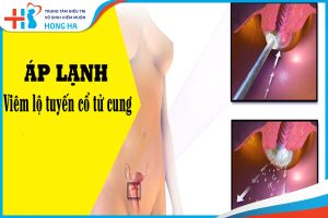Viêm lộ tuyến cổ tử cung: Lợi ích và cách áp lạnh để giảm đau, hiệu quả 80%