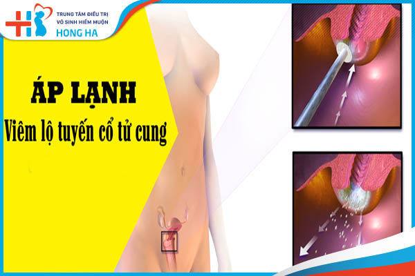 Viêm lộ tuyến cổ tử cung: Lợi ích và cách áp lạnh để giảm đau, hiệu quả 80%