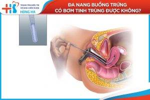 Tất cả những gì bạn cần biết về buồng trứng đa năng: Giải đáp tại đây