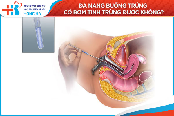 Tất cả những gì bạn cần biết về buồng trứng đa năng: Giải đáp tại đây