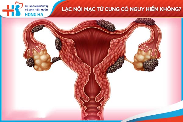 Lạc nội mạc tử cung: Nguy hiểm và tác động đến khả năng mang thai