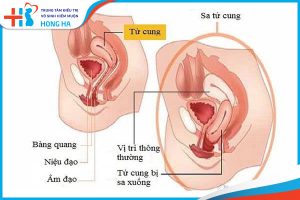 Các câu hỏi liên quan đến bệnh lý sa tử cung ở phụ nữ – Giải đáp từ chuyên gia