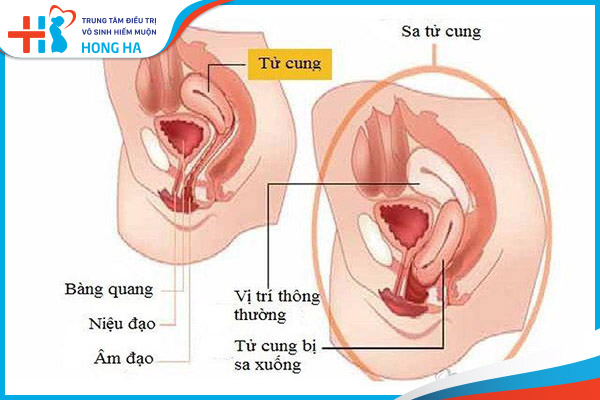 Các câu hỏi liên quan đến bệnh lý sa tử cung ở phụ nữ – Giải đáp từ chuyên gia