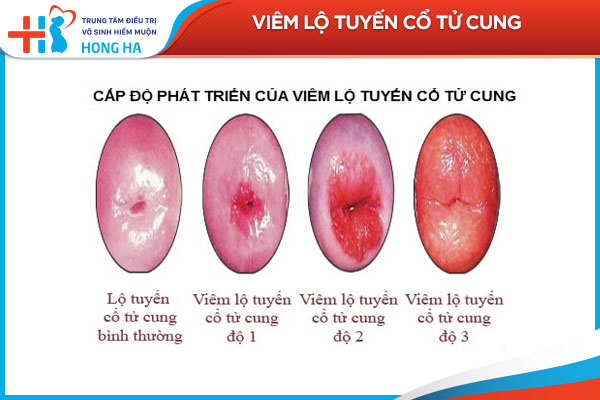 4 yếu tố ảnh hưởng đến chi phí điều trị viêm lộ tuyến cổ tử cung