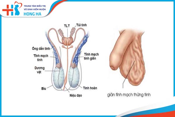 Nguy cơ và biện pháp phòng ngừa của giãn tĩnh mạch thừng tinh