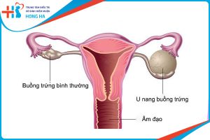 Quy trình khám u nang buồng trứng: Công dụng và kết quả