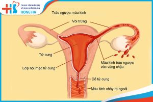 Mổ lạc nội mạc tử cung: Giải pháp hiệu quả cho rối loạn kinh nguyệt