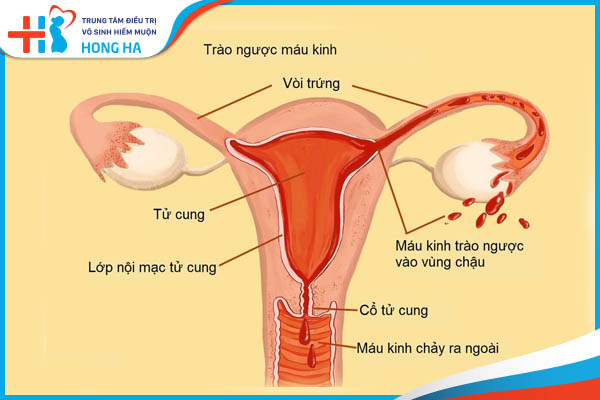 Mổ lạc nội mạc tử cung: Giải pháp hiệu quả cho rối loạn kinh nguyệt