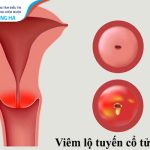 Phác đồ điều trị viêm lộ tuyến cổ tử cung hiệu quả 75%