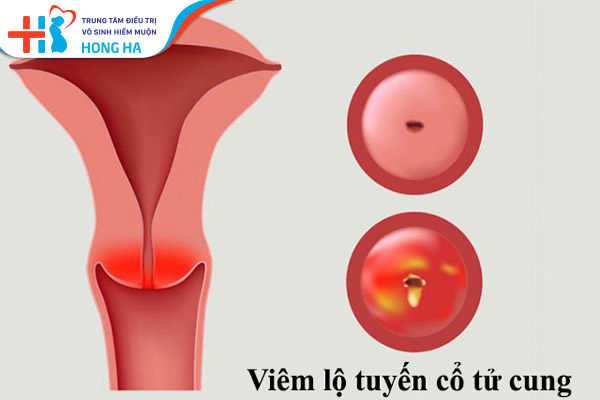Viêm lộ tuyến cổ tử cung là gì?