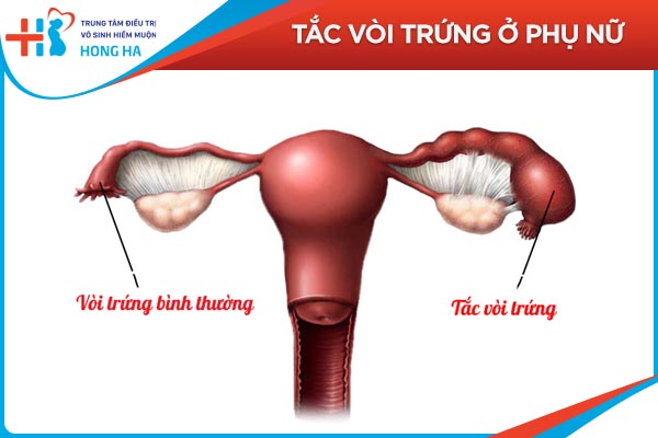 Tắc vòi trứng: Các triệu chứng và biến chứng nguy hiểm liên quan
