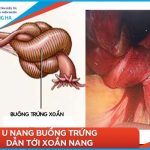 Điều trị u nang buồng trứng: Thành công cao 65% với phương pháp hiện đại