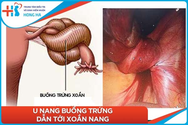 Điều trị u nang buồng trứng: Thành công cao 65% với phương pháp hiện đại