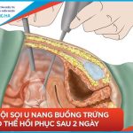 Thời gian có thể có thai sau khi mổ u nang buồng trứng: Những điều cần biết