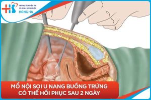 Thời gian có thể có thai sau khi mổ u nang buồng trứng: Những điều cần biết
