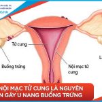 Các triệu chứng và nguyên nhân của u nang buồng trứng mà phụ nữ cần biết