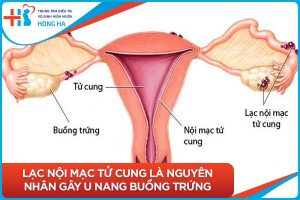 Các triệu chứng và nguyên nhân của u nang buồng trứng mà phụ nữ cần biết