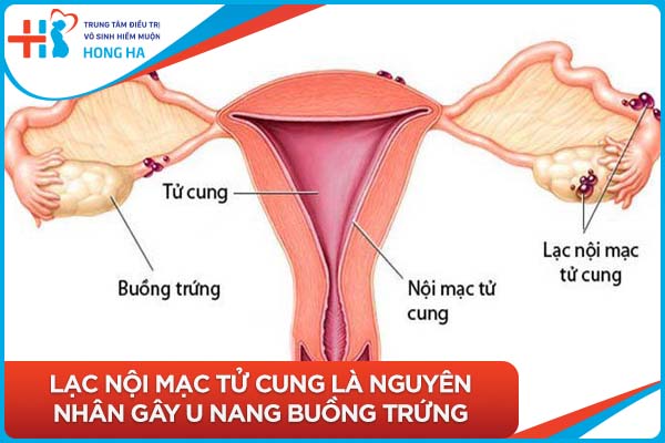 Các triệu chứng và nguyên nhân của u nang buồng trứng mà phụ nữ cần biết