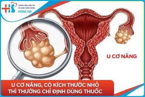 Thuốc trị u nang buồng trứng hiệu quả đến 90%: Tìm hiểu ngay