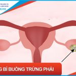 U nang bì buồng trứng: Nguyên nhân, triệu chứng và cách điều trị hiệu quả