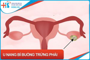 U nang bì buồng trứng: Nguyên nhân, triệu chứng và cách điều trị hiệu quả