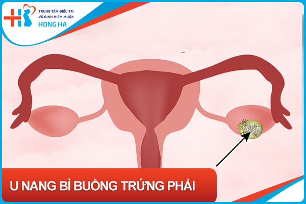 U nang bì buồng trứng: Nguyên nhân, triệu chứng và cách điều trị hiệu quả
