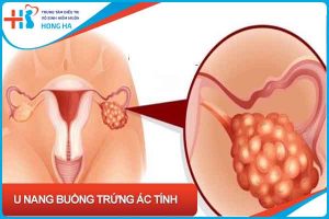 U nang buồng trứng ác tính: Nguyên nhân, triệu chứng & điều trị