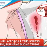 U nang buồng trứng và những thay đổi trong quá trình mang thai