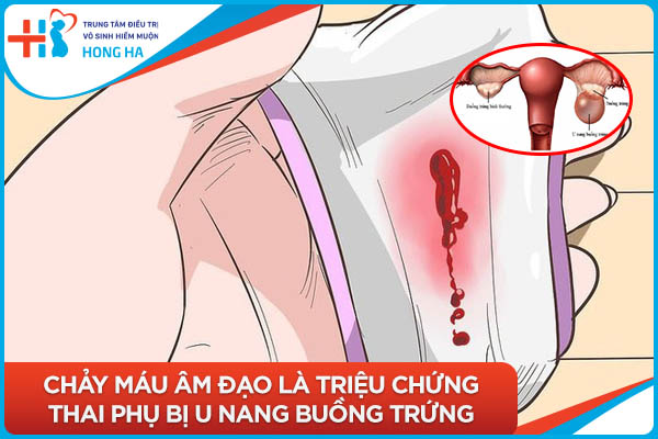 U nang buồng trứng và những thay đổi trong quá trình mang thai
