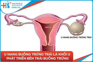 U nang buồng trứng trái: Triệu chứng, chẩn đoán và điều trị hiệu quả