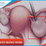 U nang nước buồng trứng: Tác động của chúng đến sức khỏe phụ nữ